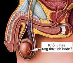 Có hạt nhỏ ở tinh hoàn 